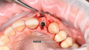 Одномоментная имплантация с костной регенерацией