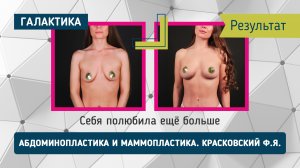 2 недели страха — и ни капли боли: абдоминопластика и маммопластика | Красковский Федор Янович