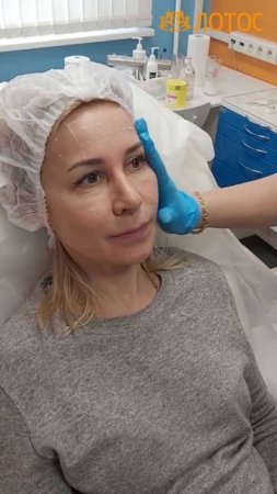 Ботулинотерапия