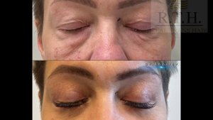 Блефаропластика или подтяжка бровей?
Какую операцию выбрать?