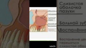 ПроЗдоровье.Операция на верхнечельстной пазухе.Серия5.mp4