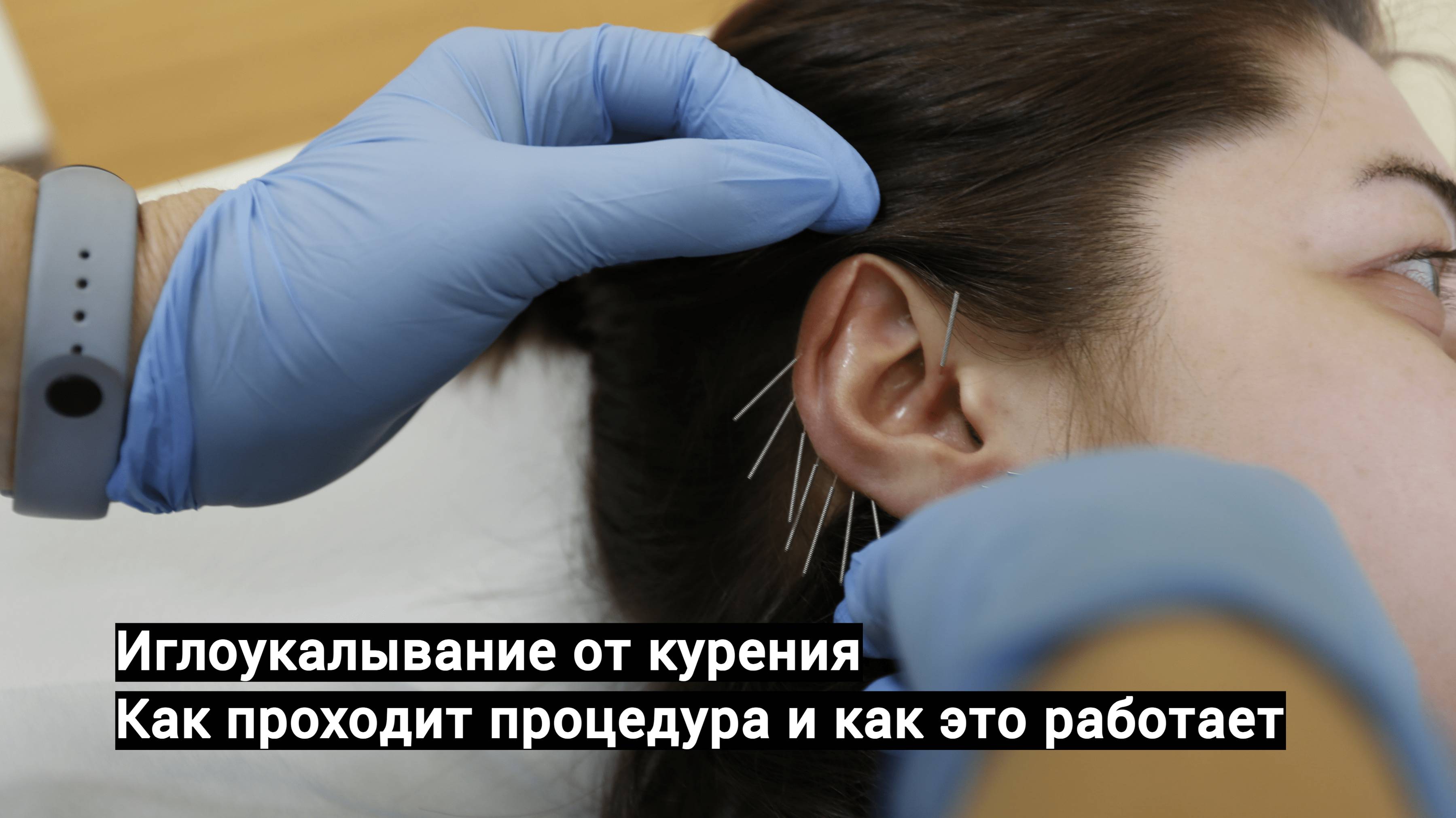 Иглоукалывание от курения — как проходит процедура и как это работает