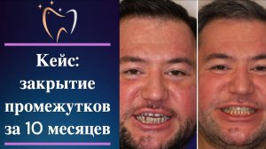 💎 Кейс: исправление прикуса и закрытие промежутков за 10 месяцев