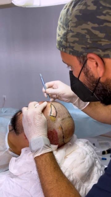 #hair #shorts #пересадкаволос #explore смотреть онлайн