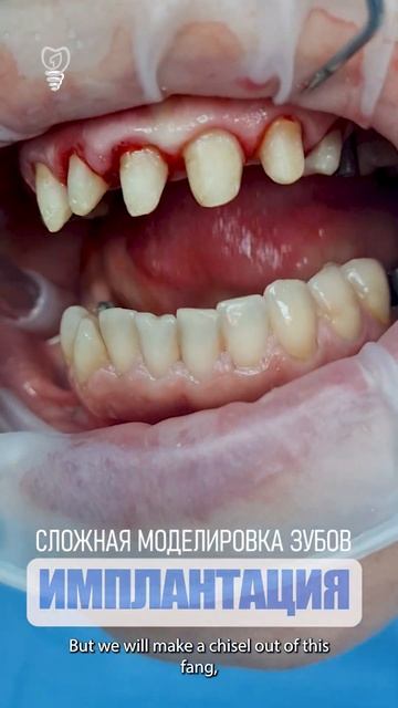 Сложная моделировка зубов. Complex modeling of teeth.