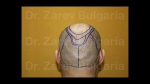 Dr. Zarev hair transplant 11080 grafts / Д-р Зарев трансплантация на кос?