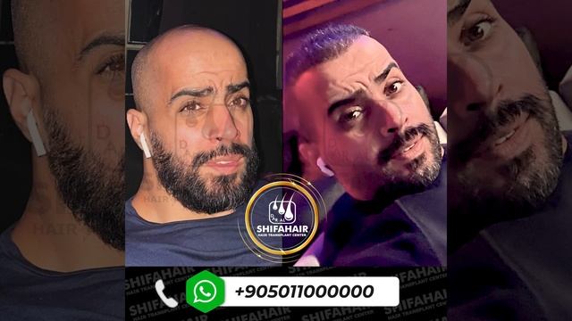 Опыт одного из наших клиентов по пересадке волос. Запи