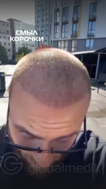 Мой опыт пересадки волос в Турции! globalmedik пересадкаво