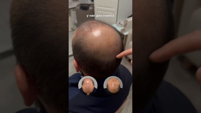 У нас такой рост всего за 2 месяца после пересадки 🔥 смотреть онлайн