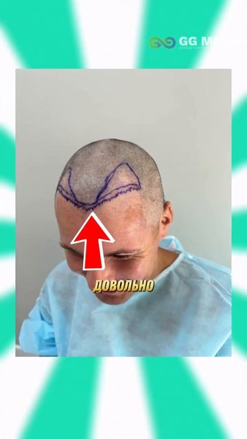 ПЕРЕСАДКА ВОЛОС 213 смотреть онлайн