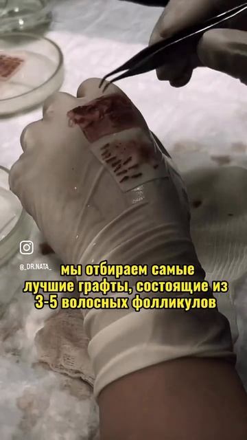 Донорская зона после  пересадки волос