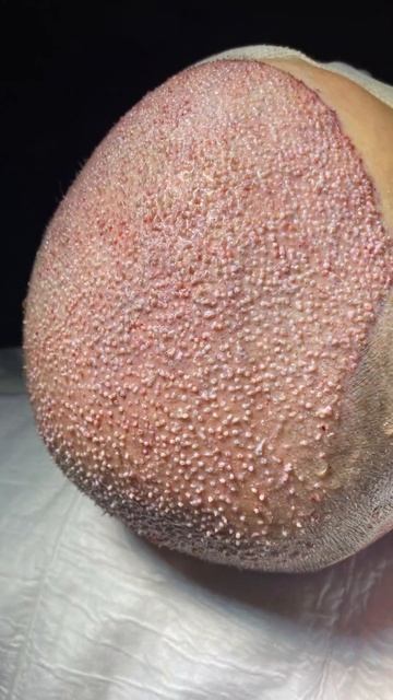 Пересадили  FUE 4.450 графтов. Пересадка волос#стамбул #ту? смотреть онлайн