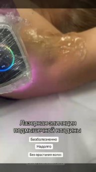 Эпиляция подмышецной зоны