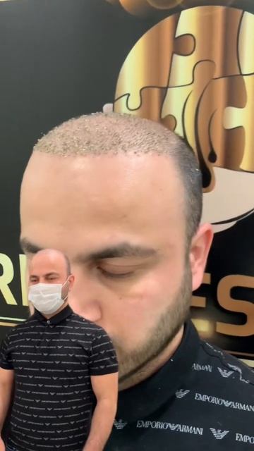 Пересадка волос в Москве отлично операции #пересадкав смотреть онлайн