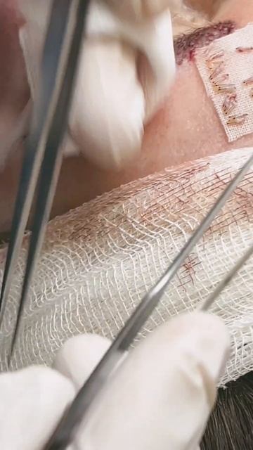 Пересадка бровей. #пересадкаволос #brows #shortvideo #clinic #beautifu