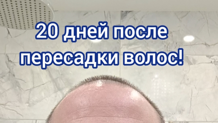 20 дней после пересадки волос. Успехи и неудачи...