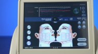 Аппарат SMAS 2D, лифтинг, подтяжка, HIFU