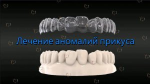 🛠 Лечение аномалий прикуса на элайнерах