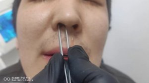 Силиконовые сплинты