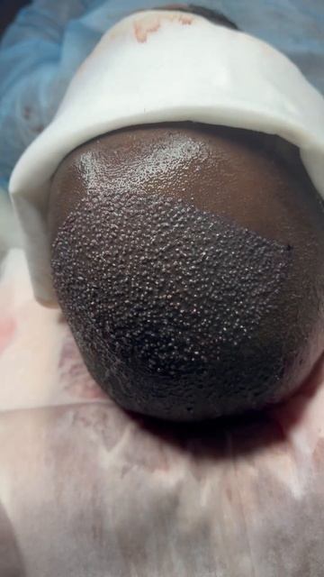 Последняя операция по пересадке волос в 2023 году #перес смотреть онлайн