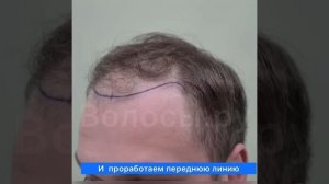 Пациент 22 года. Пересадка 2500 графтов в передне-централ