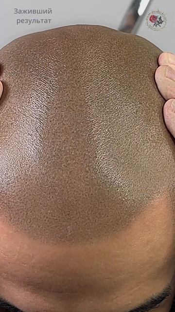 Заживший результат Трихопигментация тату волос лучше смотреть онлайн