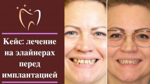 💎 Кейс: лечение на элайнерах перед имплантацией
