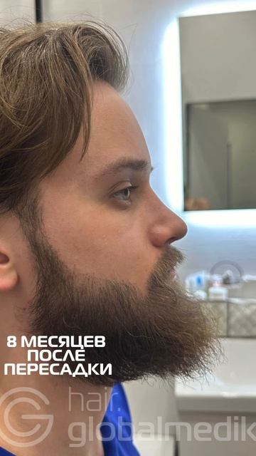 Пересадка бороды: как это работает #globalmedik #пересадкав?