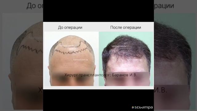 Результаты пересадки волос HairMed