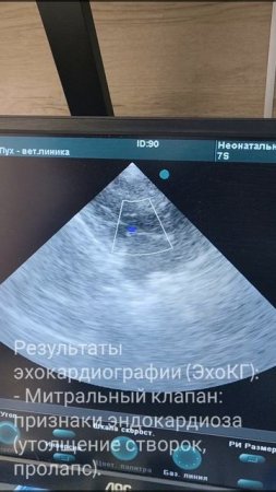 📄 Клинический случай: эндокардиоз митрального клапана