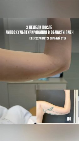 Промежуточный результат после липоскульптурирования в области плеч, через 3 недели после операции