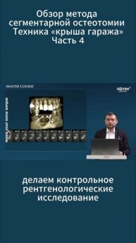 Лекция: "Обзор метода сегментарной остеотомии. Техник?