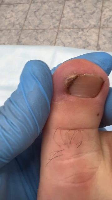 ✅ Вросший ноготь #вросшийноготь #вросшиеногти #ногти # смотреть онлайн