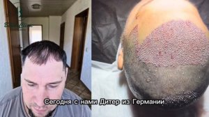 Первый отчет через 4 месяца после пересадки волос