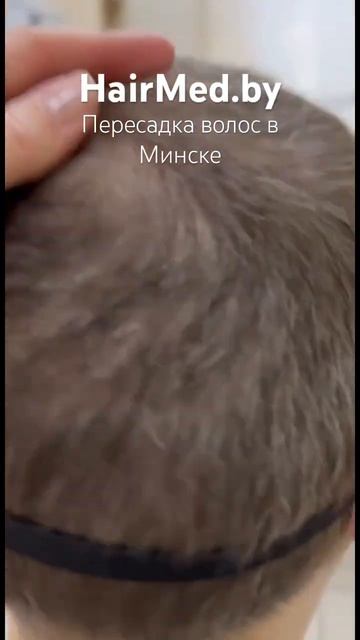HairMed.by | Пересадка волос в Минске