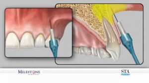 Инфильтрационная анестезия | Обзор