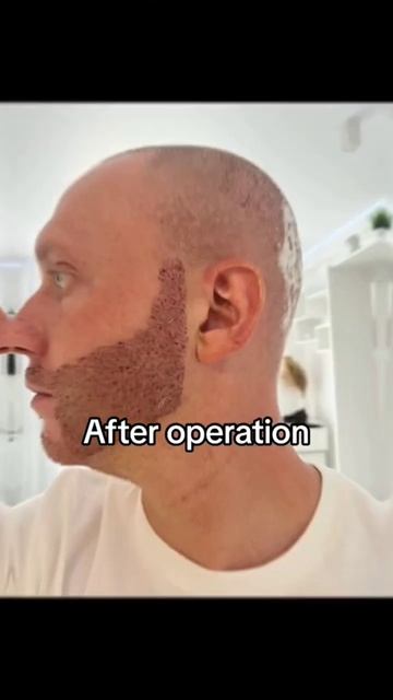 Beard Transplant Result | Пересадка  Бороды | #beardtransplant #пересадкаб