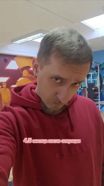 Прошло почти 4.5 месяца после операции по пересадке вол смотреть онлайн