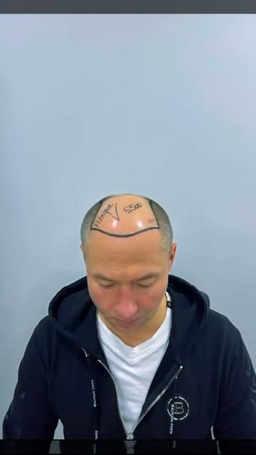 Пересадка волос Стамбул HelpU unique смотреть онлайн