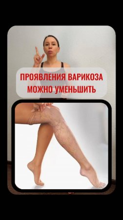 Проявление варикоза можно уменьшить.