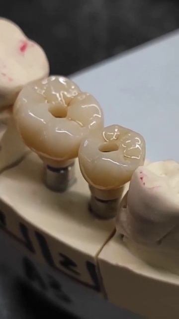 два импланта | трансокклюзия #shorts смотреть онлайн