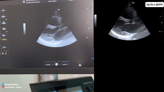 Как измерить Qp/Qs в ЭхоКГ? Простое объяснение смотреть онлайн