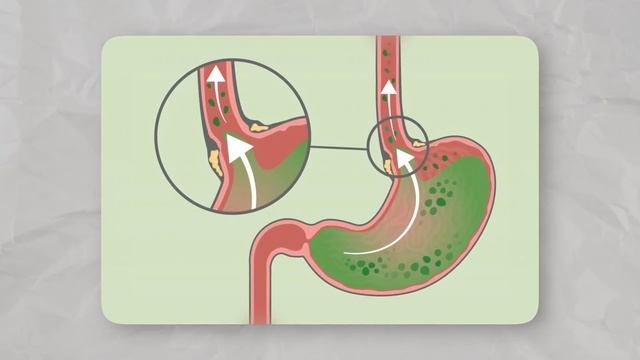 Неприятный запах изо рта? Большая проблема с ЖКТ! смотреть онлайн