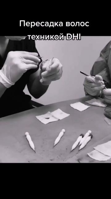 Пересадка волос в Турции. Пересадка волос методом DHI смотреть онлайн