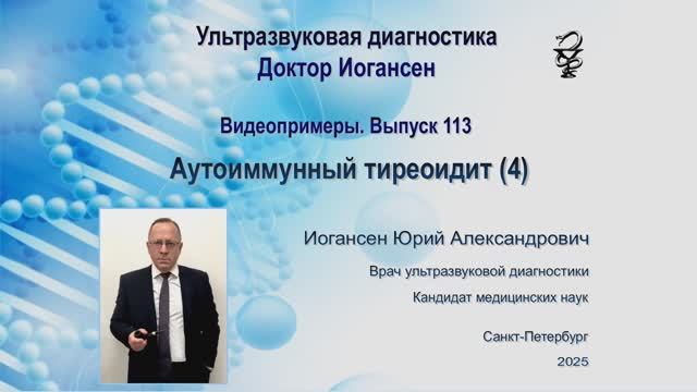 УЗИ. Доктор Иогансен. Видеопримеры. Выпуск 113. Аутоиммунный тиреоидит (4).