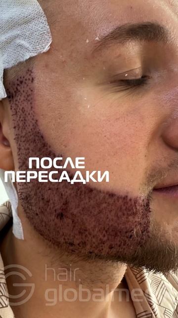 4 месяца после пересадки бороды #globalmedik #пересадкаволо?