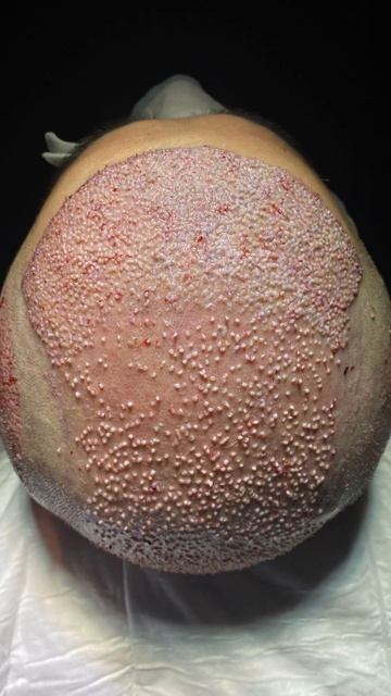 До и после спустя 6 месяцев. Пересадка волос. #стамбул #? смотреть онлайн