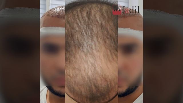 Результат после пересадки волос | девятый месяц | 4200 гр