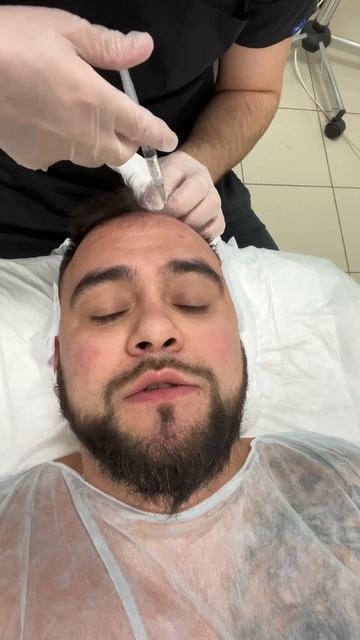 Кто боится уколов, лучше не смотреть))) #пересадкаволос смотреть онлайн