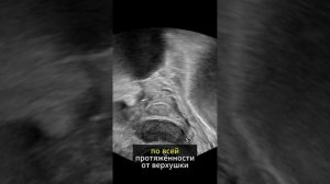 Рак предстательной железы. ТРУЗИ.